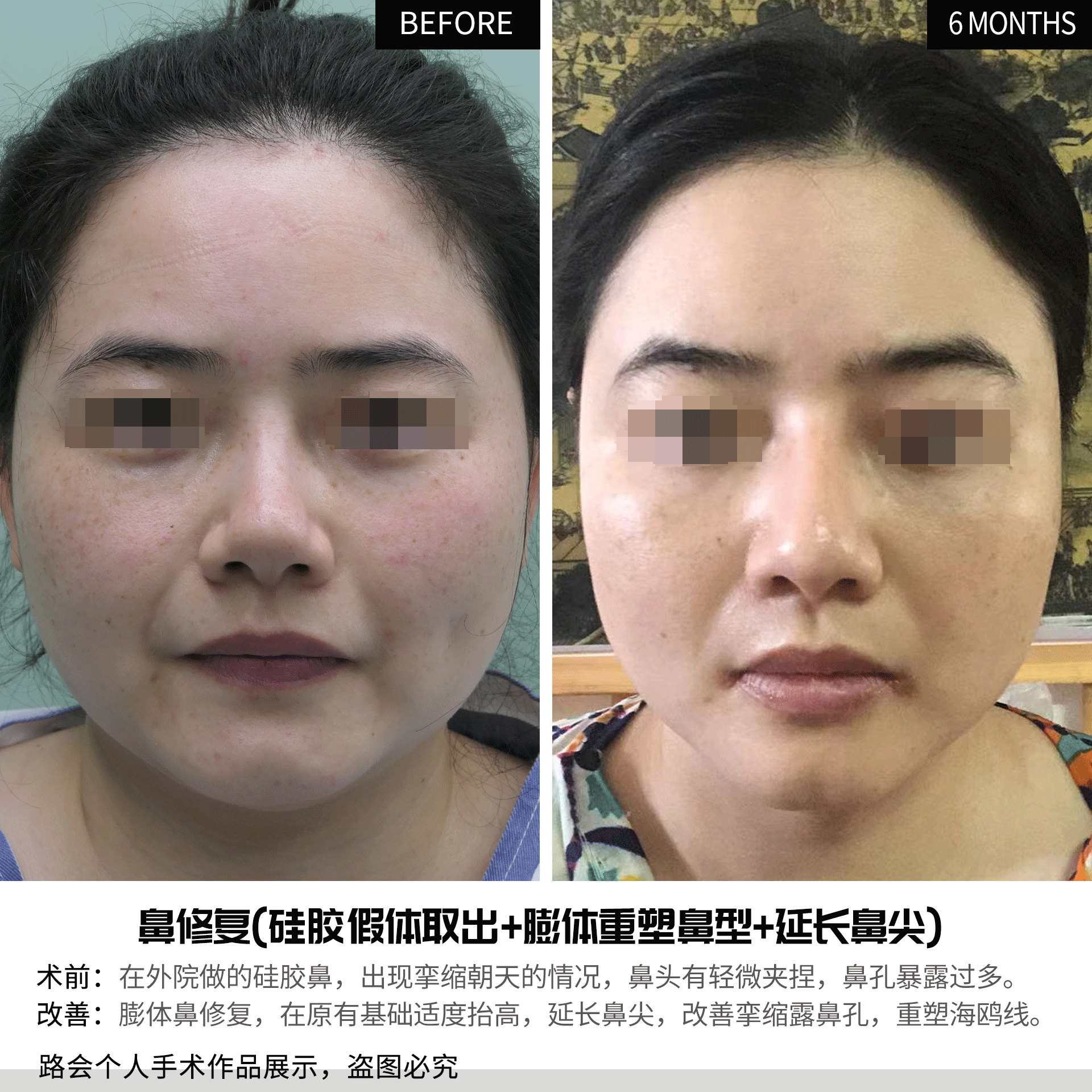 硅胶隆鼻│那些整形医生不会告诉你的,隆鼻手术的“副作用” 图片-10