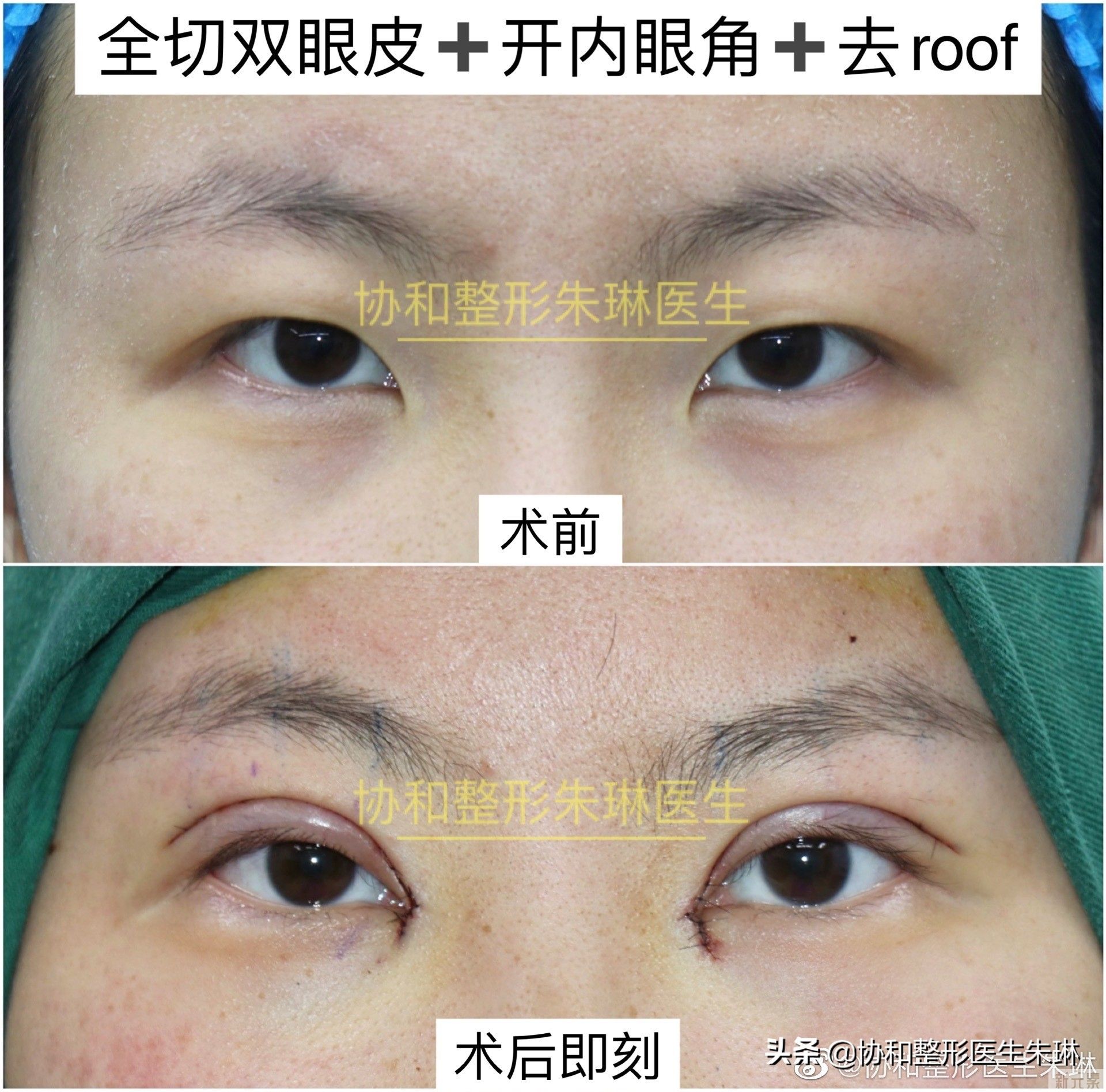 今日案例，全切双眼皮➕开内眼角➕去roo 图片-1