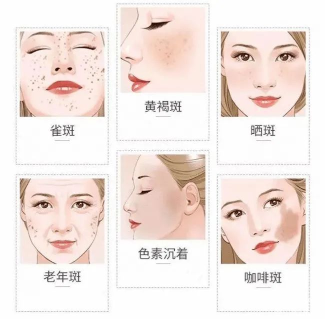 科学来看，斑有多影响颜值?!请启动您的“祛斑”计划! 图片-5
