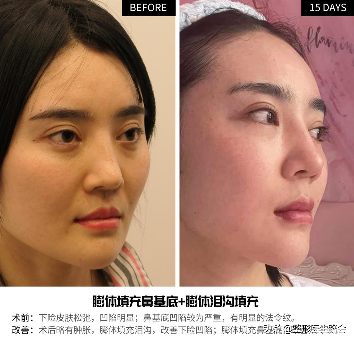 40+、50+法令纹明显，是做“面部提升”?还是“鼻基底填充”? 图片-4