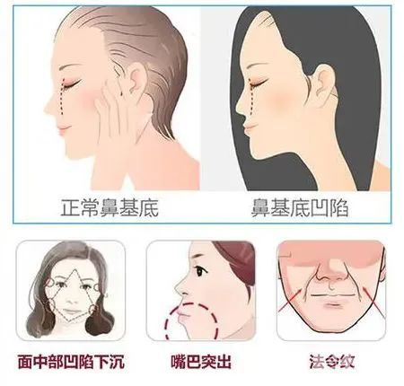 如何精准改善法令纹? 图片-8