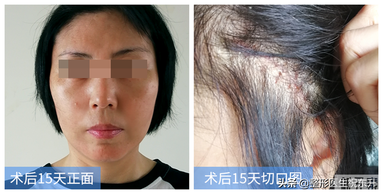 做了拉皮手术，场面血淋淋、疼得哇哇叫?你想多了 图片-4