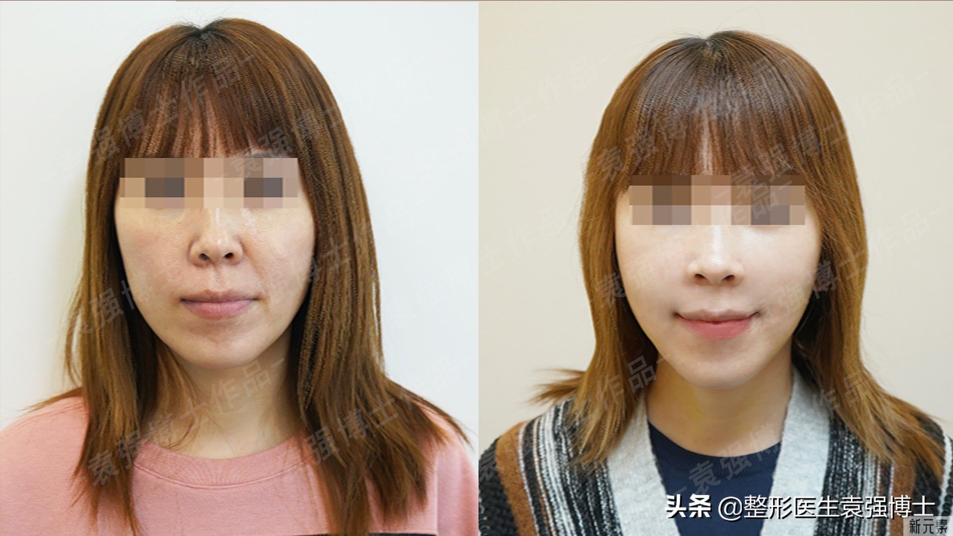 拉皮才10天，太“惊艳”了! 图片-1