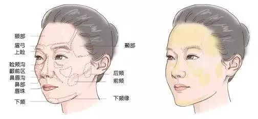 如何改善面部凹陷? 图片-3