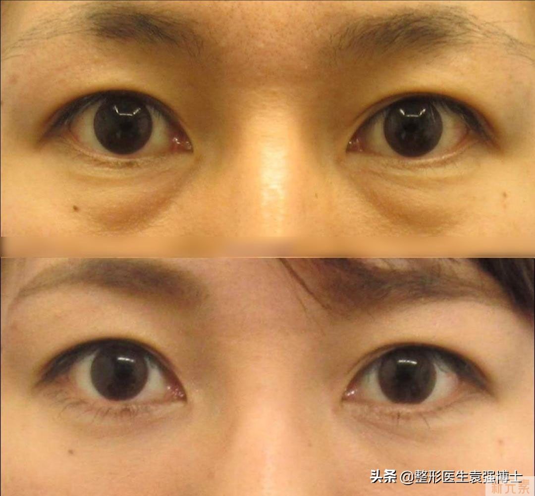 眼袋手术后一定会经历这些事(医生总结) 图片-1