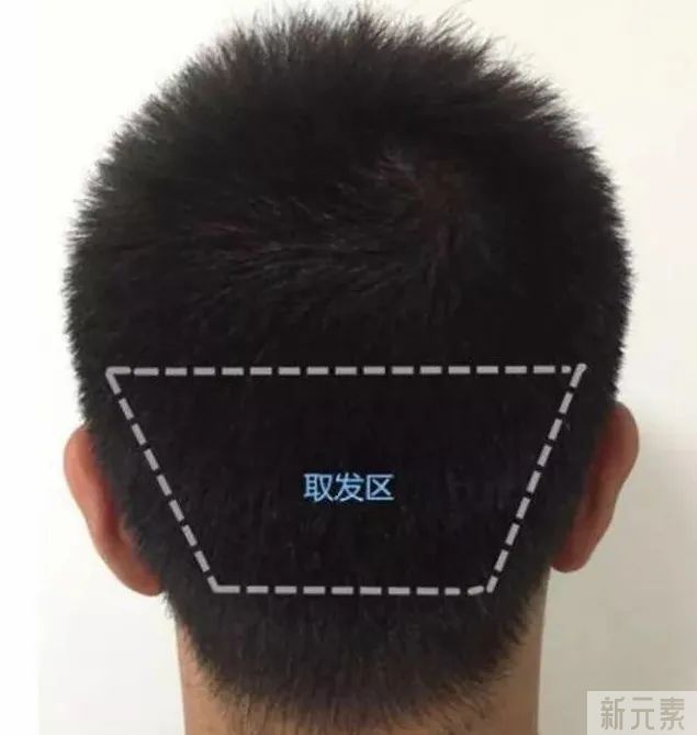 后枕部毛囊的特别之处，您知多少? 图片-2