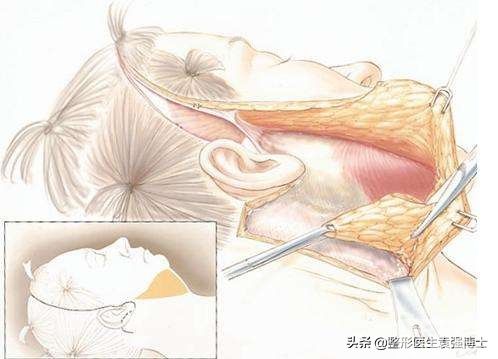 10个求美者最常问的问题，说说我对拉皮手术的一些看法 图片-1