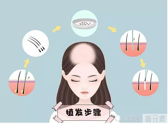植发手术为什么会失败?90%的原因是...... 图片-5