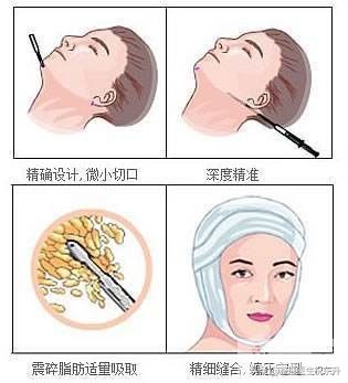 【吸脂后面部松弛，还有可能恢复吗?】 图片-1