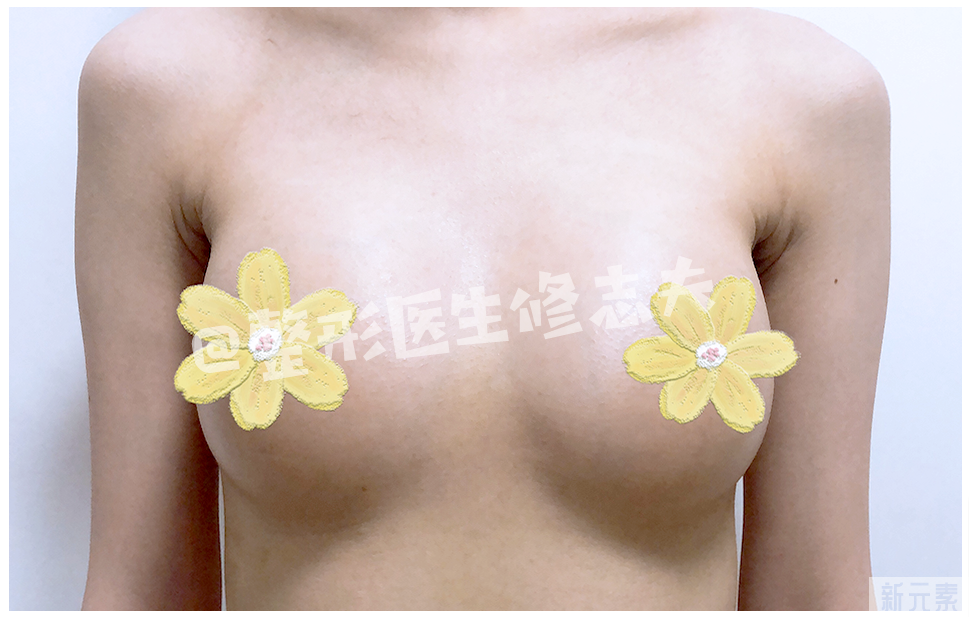 假体隆胸和脂肪丰胸都想要?没问题，安排 图片-6