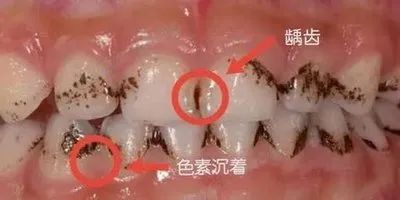 儿童牙齿上的黑色素是龋齿?能去掉吗? 图片-5