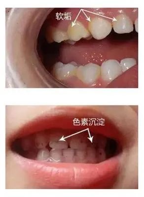 儿童牙齿上的黑色素是龋齿?能去掉吗? 图片-3