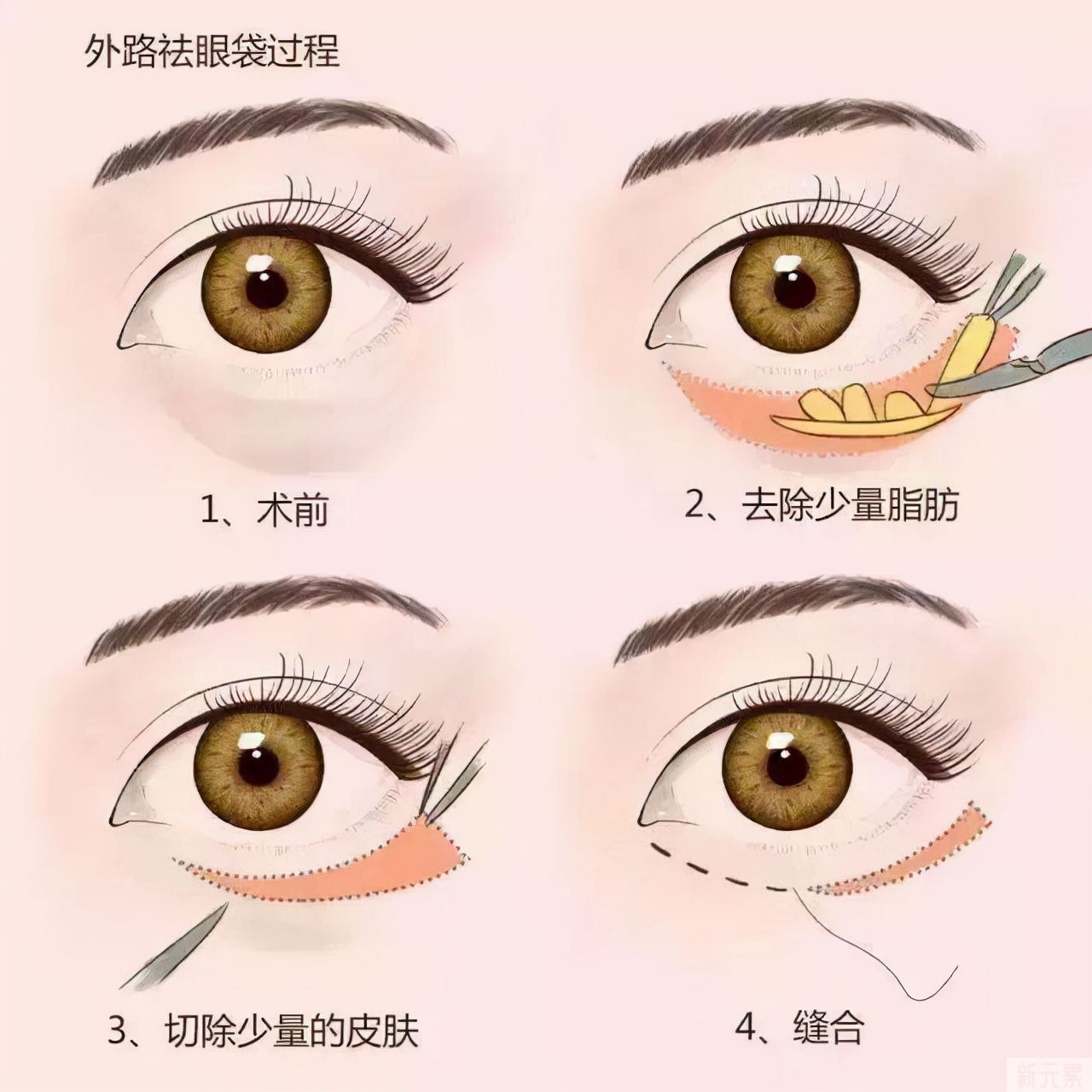 你知道形成眼袋的4大原因是什么吗? 图片-6