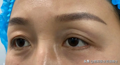 上眼皮耷拉、松弛的2种解决方法，医生说性价比高 图片-3