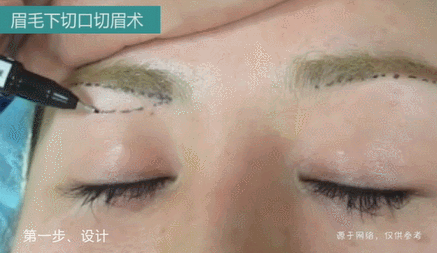 上眼皮耷拉、松弛的2种解决方法，医生说性价比高 图片-2