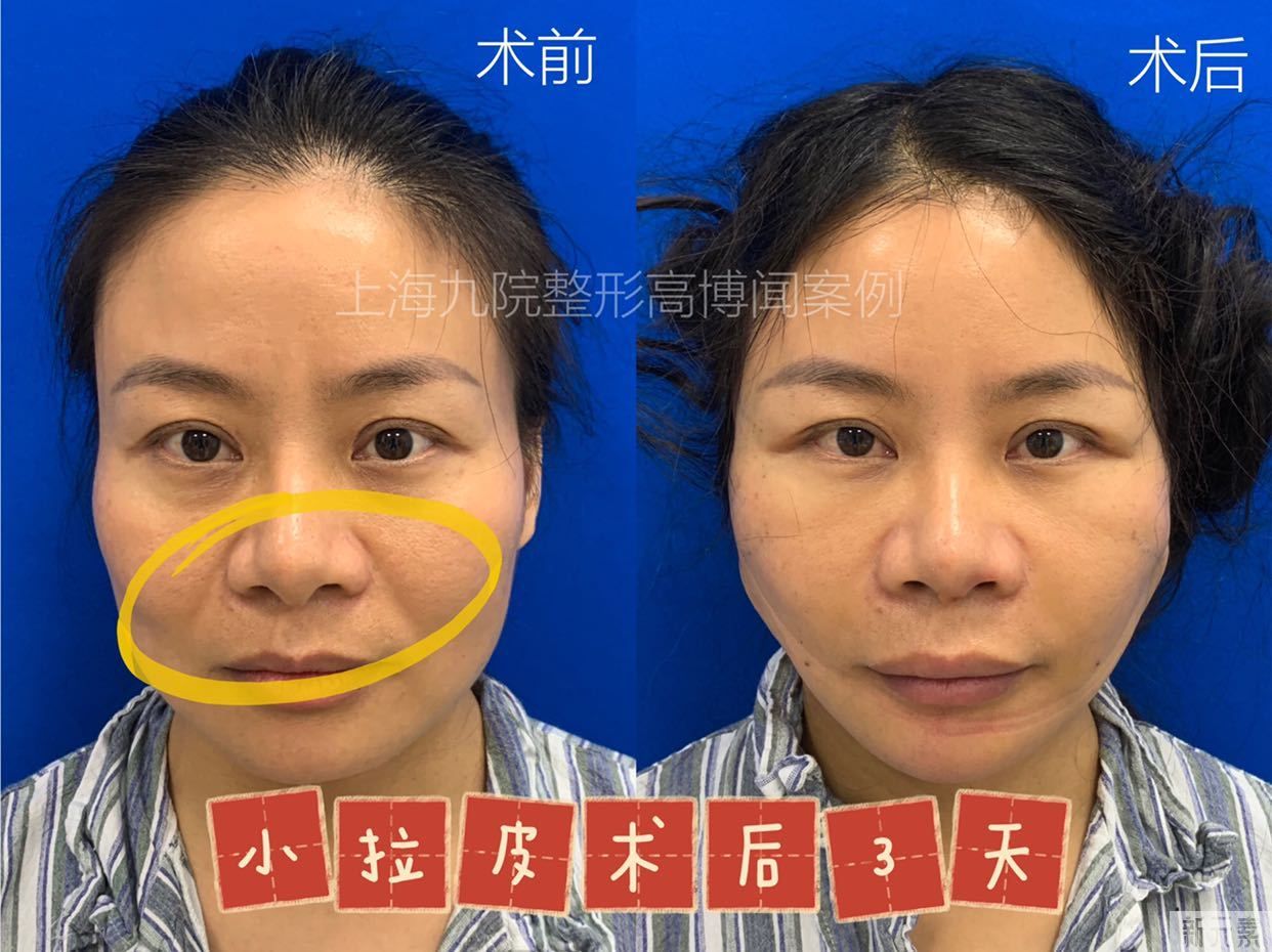 拉皮手术毁容了?先看看手术做了多久吧 图片-2