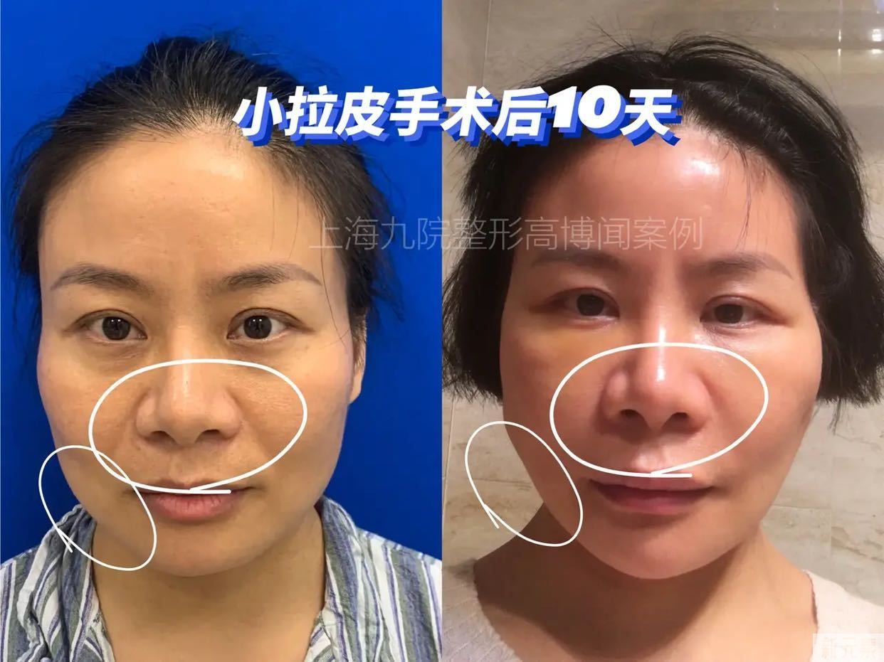 拉皮手术毁容了?先看看手术做了多久吧 图片-3