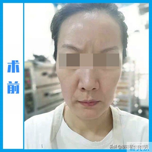 小拉皮术后73天，反馈来了!这或许才是“中老年少女”的真相 图片-1