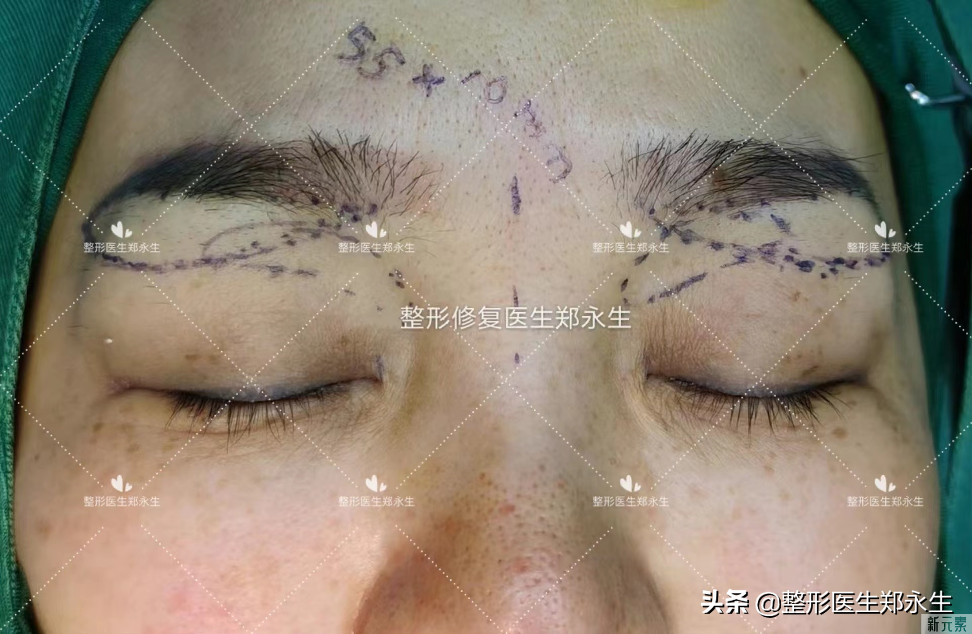 一定要先了解这几件事，再去做提眉手术 图片-4