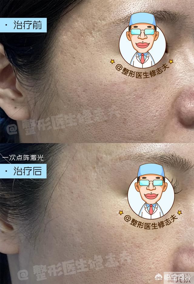 毛孔粗怎么解决? 图片-3