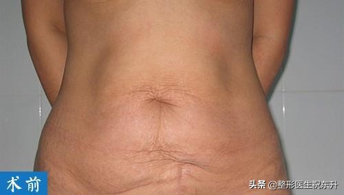 腹壁整形术后3个月，这几张照片，“赤裸裸”地展示了真实经历 图片-2