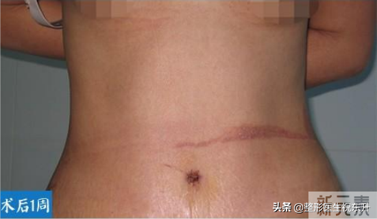 腹壁整形术后3个月，这几张照片，“赤裸裸”地展示了真实经历 图片-3