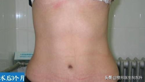 腹壁整形术后3个月，这几张照片，“赤裸裸”地展示了真实经历 图片-4