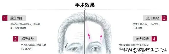 提眉术能解决什么问题? 图片-1