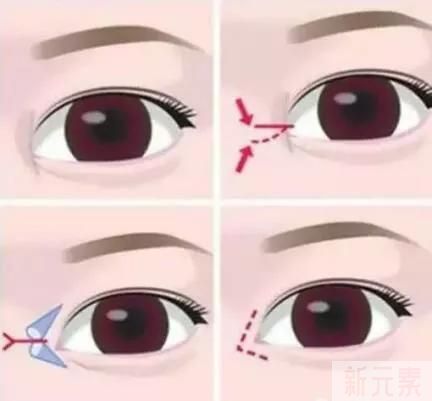 做双眼皮要不要开眼角呢? 图片-1