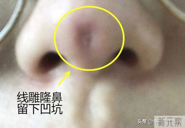做鼻整形我只有两点要求:必须创伤小，必须能蹦极 图片-3