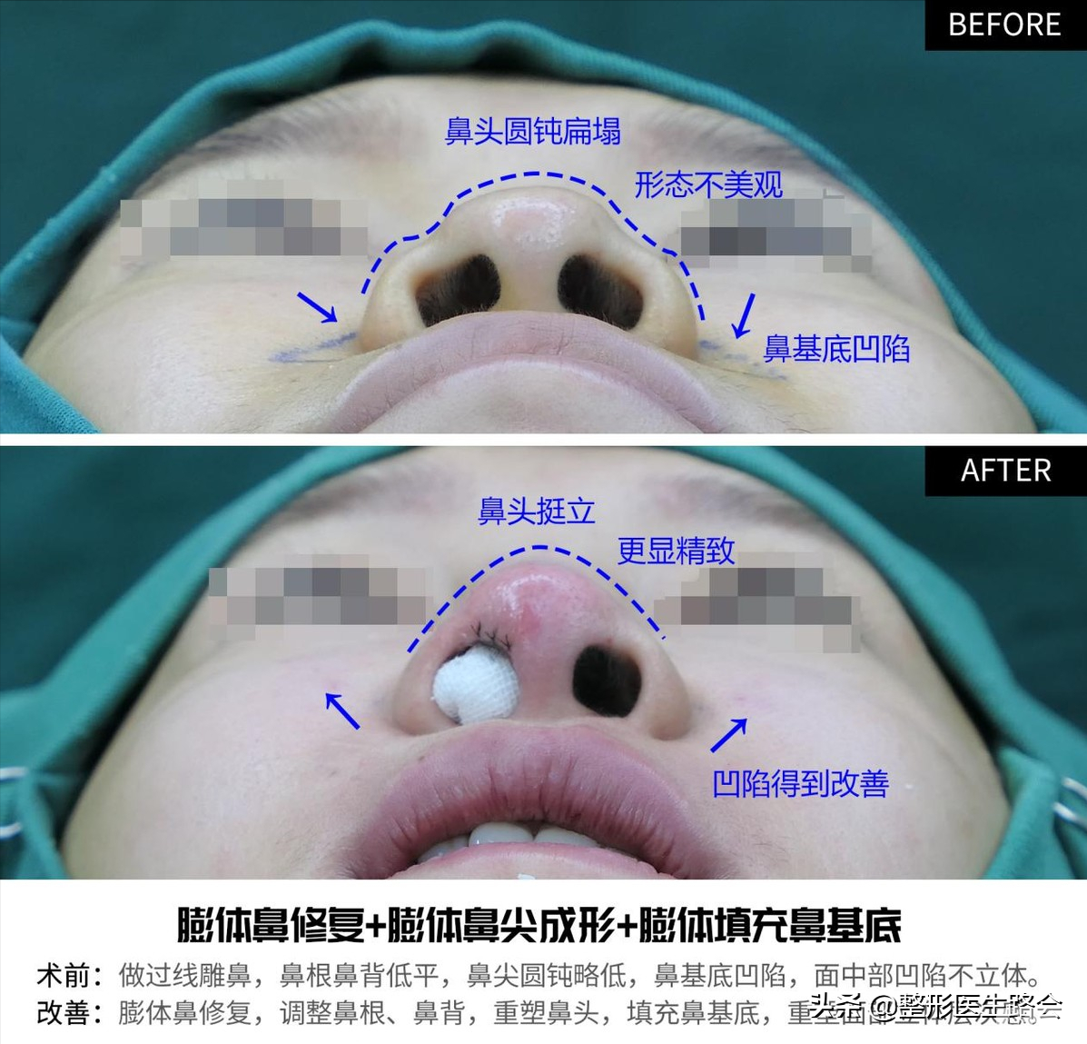 做鼻整形我只有两点要求:必须创伤小，必须能蹦极 图片-12