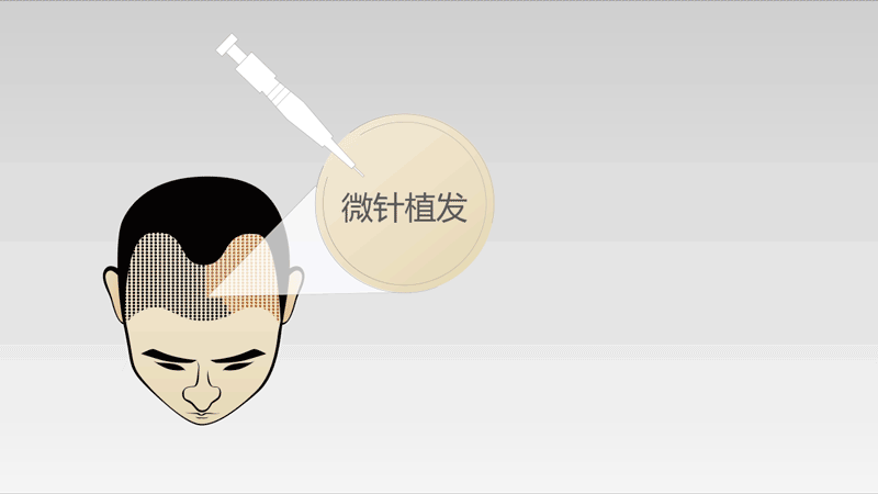 植发小白进