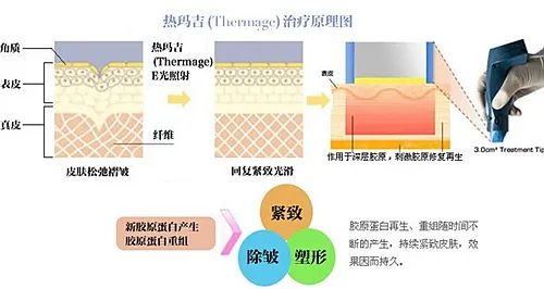 关于热玛吉的常见问题 图片-4