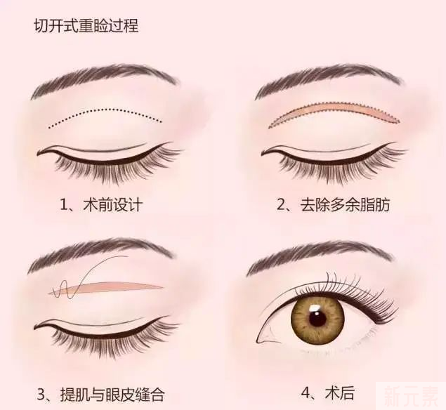 医美小白第一次面诊双眼皮，到底要问啥~ 图片-3