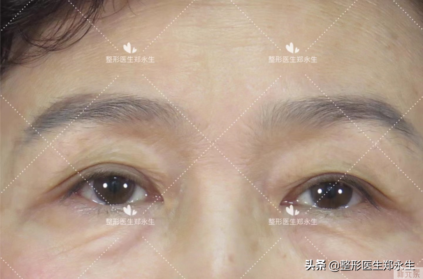 53岁做完提眉+眼袋手术后1个月，和大家谈谈我的一些感受 图片-1