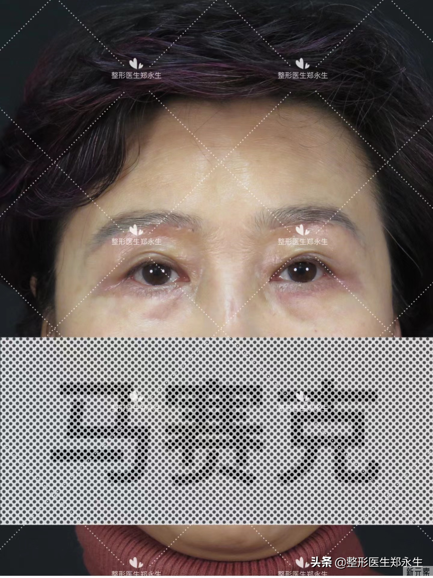53岁做完提眉+眼袋手术后1个月，和大家谈谈我的一些感受 图片-2