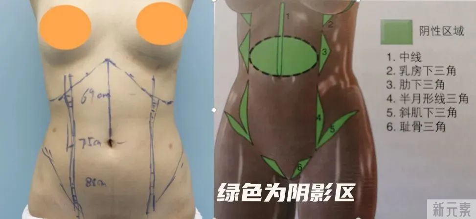 春季吸脂减肥的最高境界!人瘦了，马甲线也有了 图片-8