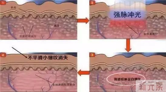 【限时秒杀】皮肤干燥粗糙，选择光子嫩肤还是水光治疗好呢? 图片-3