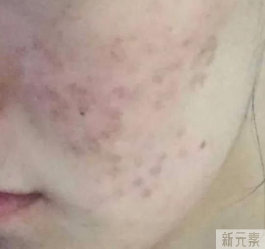 痘印应该怎么办? 图片-5