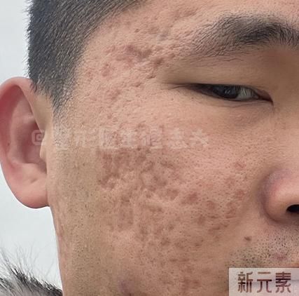 痘印应该怎么办? 图片-7