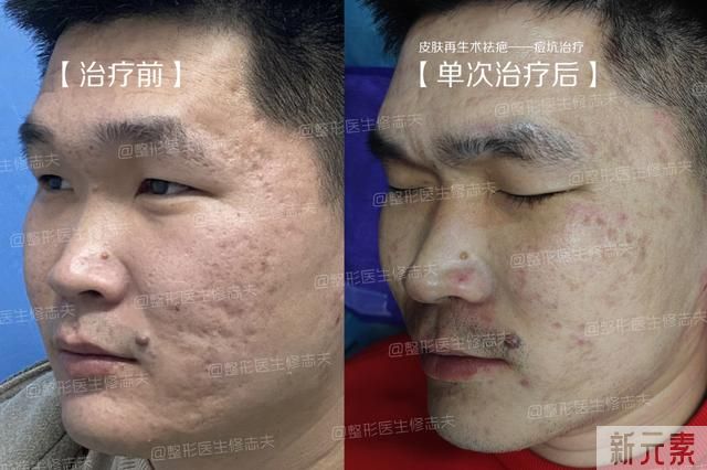 痘印应该怎么办? 图片-8