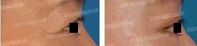 上面部提升 