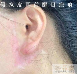 闺蜜做大拉皮“毁容”了，我真的怕了! 图片-1