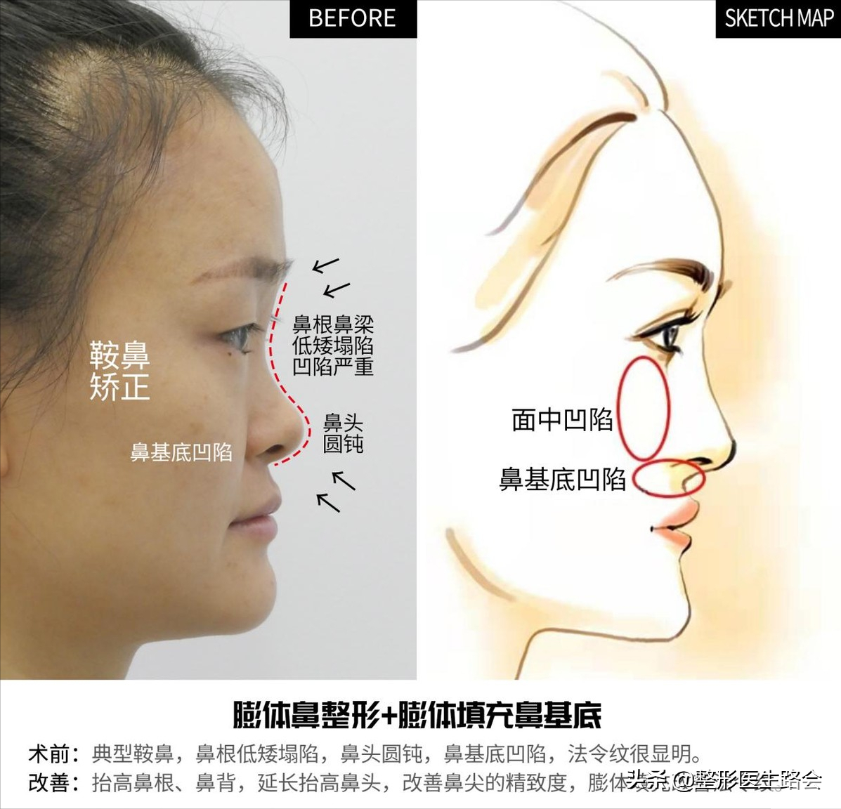 30岁“隆鼻+鼻基底填充”效果真实记录，5个月“惊艳”所有人 图片-3