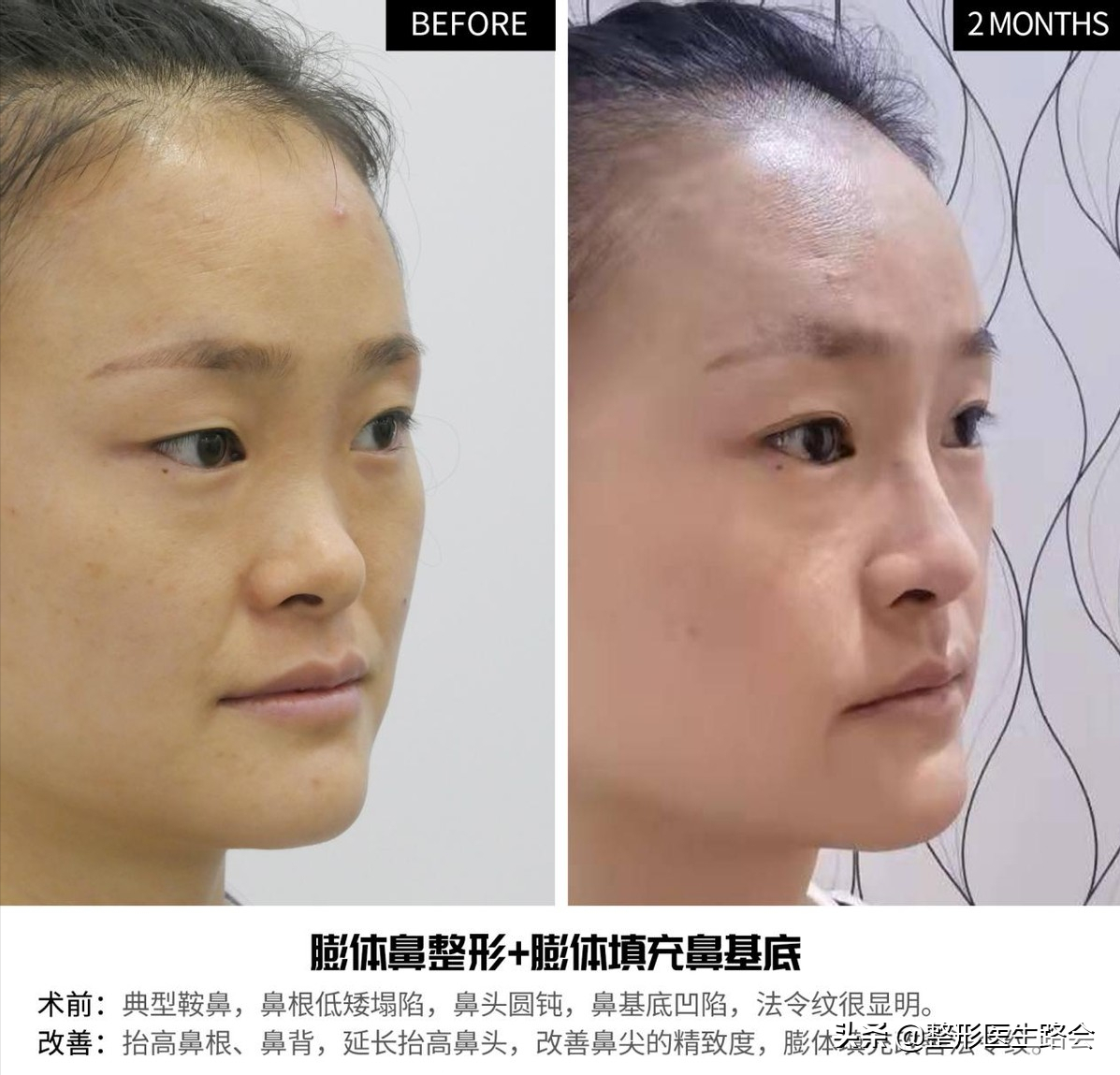 30岁“隆鼻+鼻基底填充”效果真实记录，5个月“惊艳”所有人 图片-5