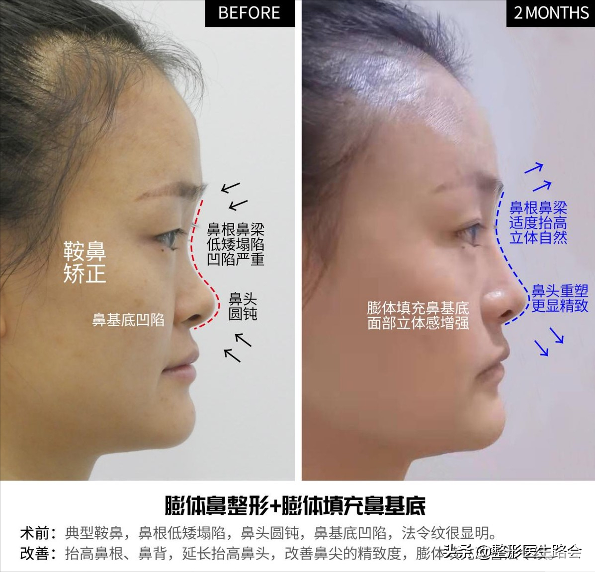 30岁“隆鼻+鼻基底填充”效果真实记录，5个月“惊艳”所有人 图片-6