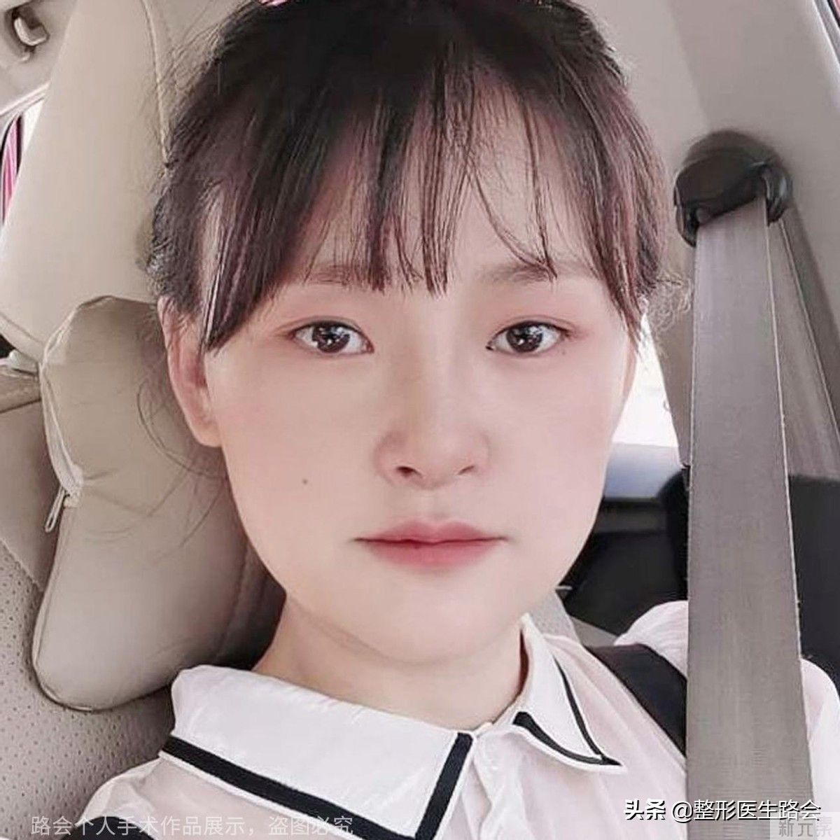 30岁“隆鼻+鼻基底填充”效果真实记录，5个月“惊艳”所有人 图片-8