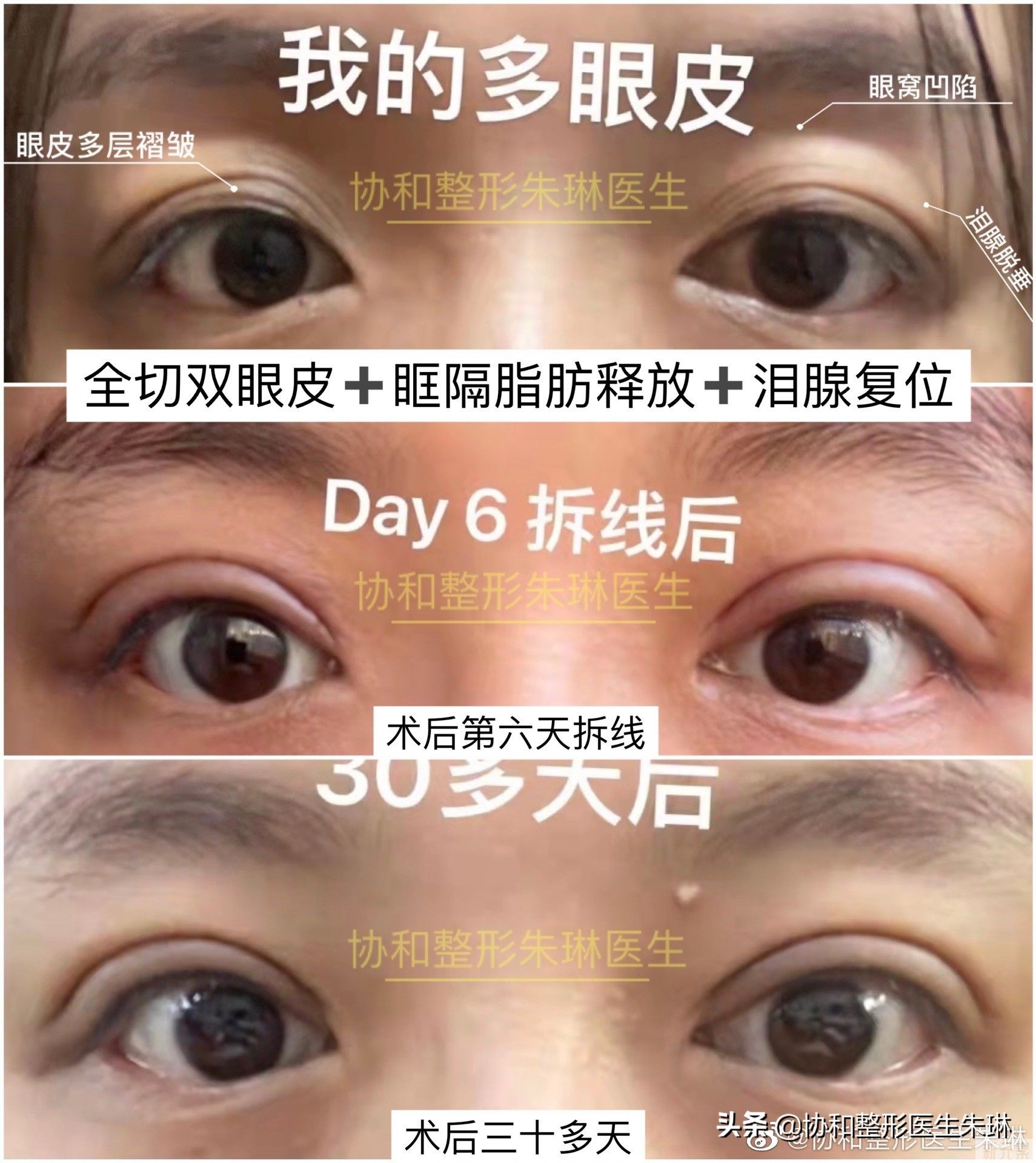 今日案例，全切双眼皮+眶隔脂肪释放+泪腺 图片-1