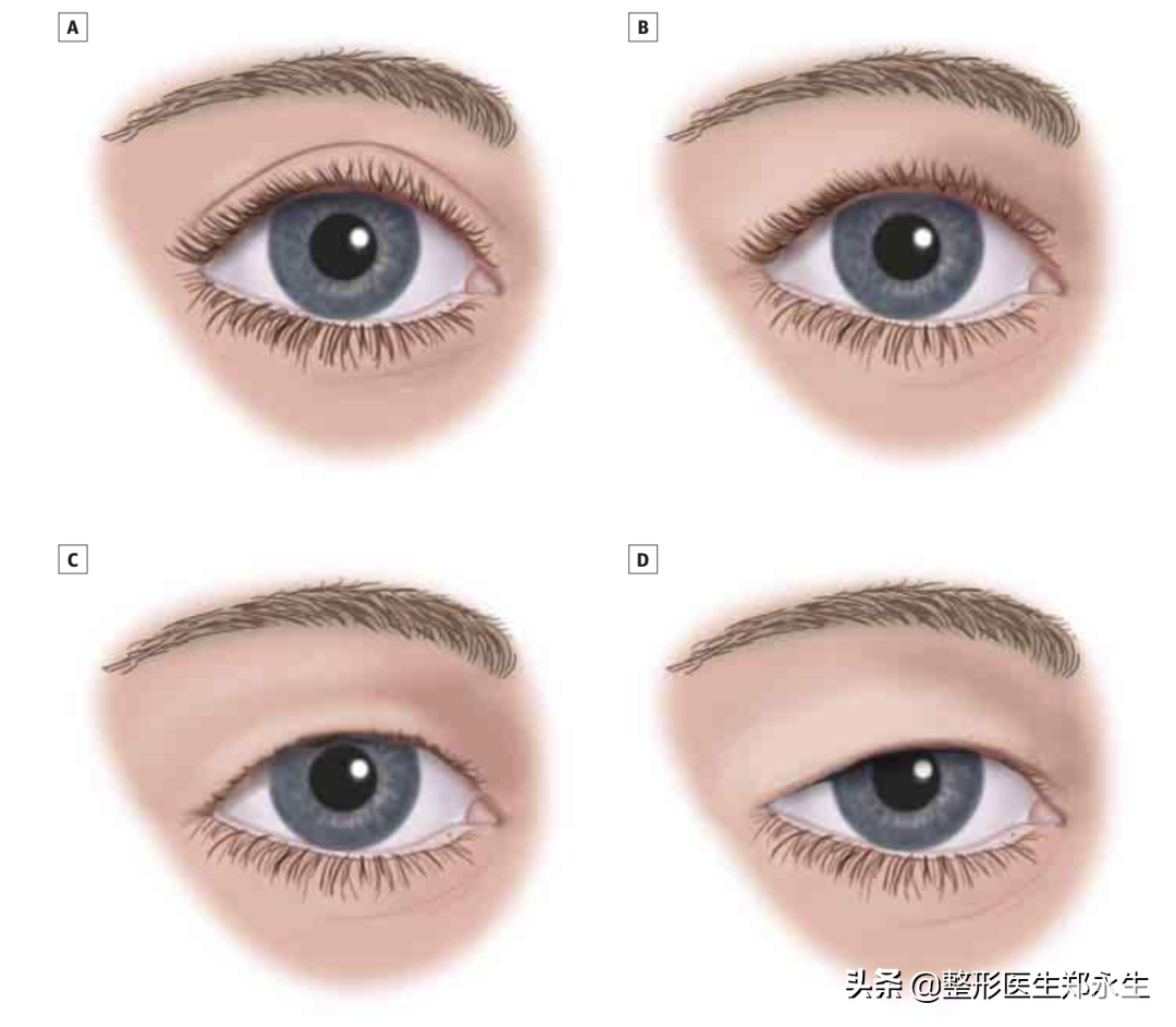 怎么判断上眼皮松弛，这个方法很少人知道-看完你就懂了 图片-1