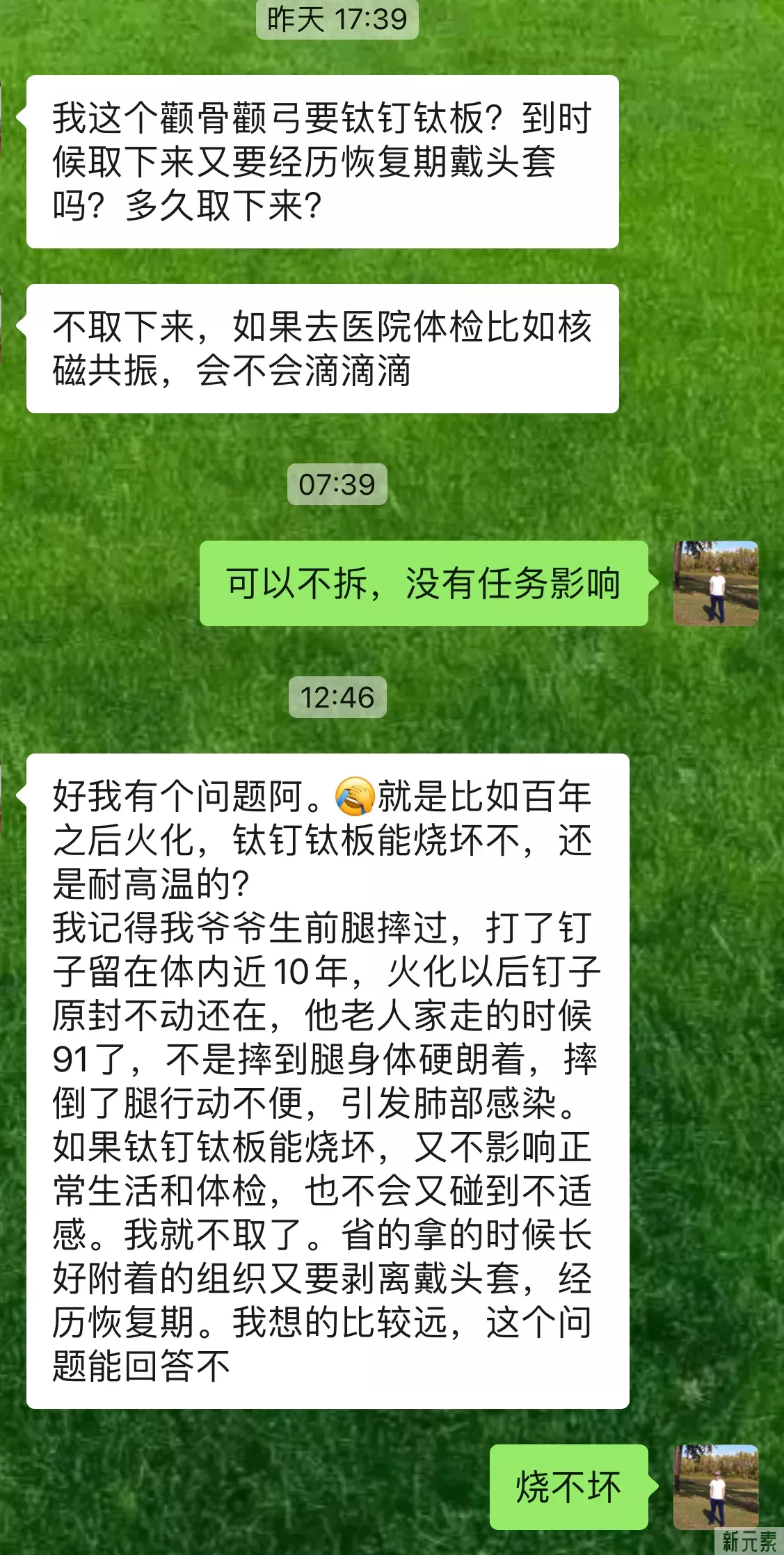 一个做颧骨的妹子，问固定的钛板要不要取? 图片-1